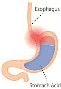 Gastro-esophageal Reflux (GER)