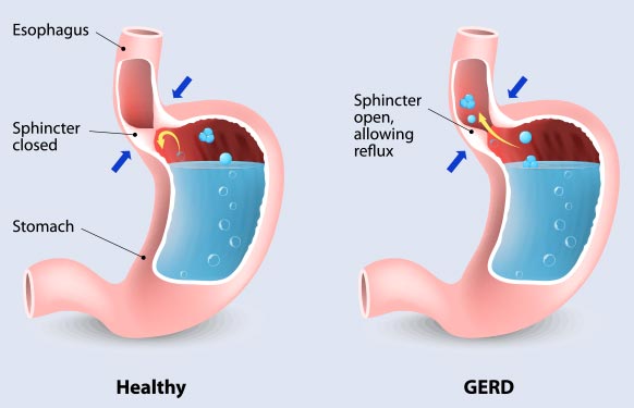 Gastroesophageal Disease (GERD)